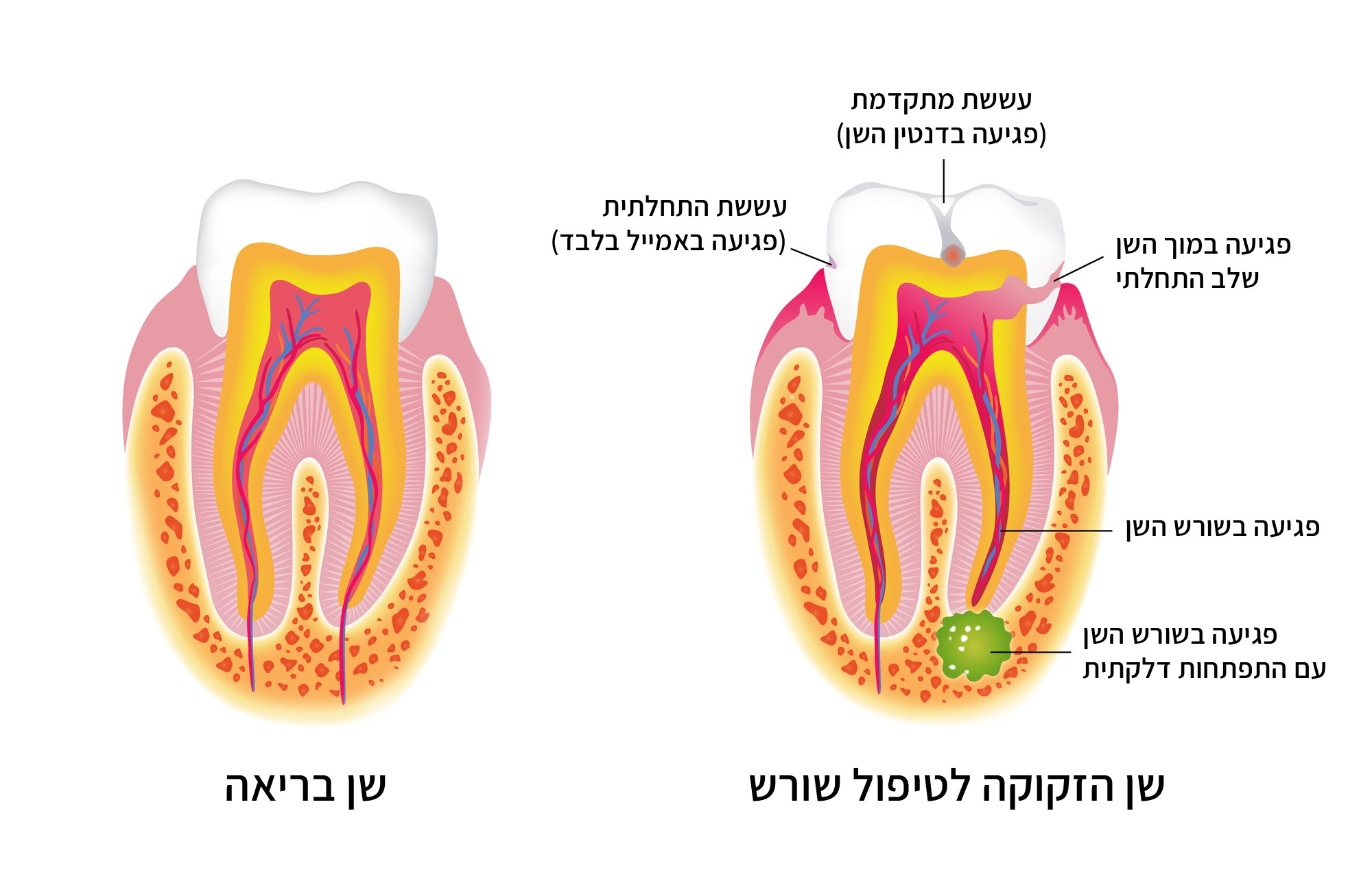 איור שן הזקוקה לטיפול שורש