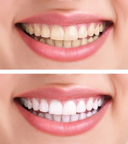 הלבנת שיניים תמונת לפני / אחרי טיפול