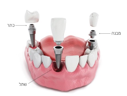 שתלים דנטליים | איור מבנה, שתל וכתר