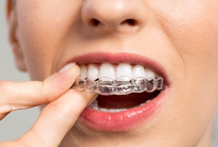 יישור שיניים בשיטת הקשתיות השקופות