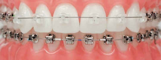 יישור שיניים בשיטת הקשתיות השקופות