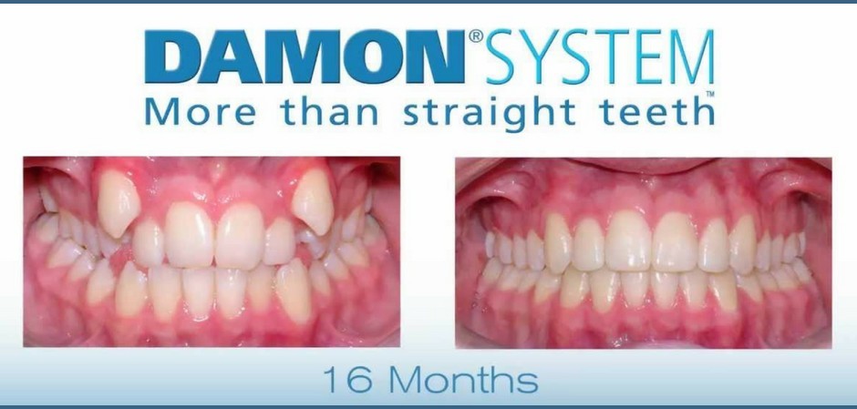 יישור שיניים בשיטת Damon System