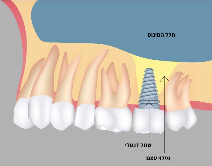 הרמת סינוס